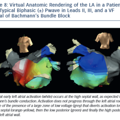 Figure 8 Virtual Anatomic Rendering of the LA in a Patient with Typical Biphasic ± Pwave in Leads II III and a VF Typical of Bachmann’s Bundle Block
