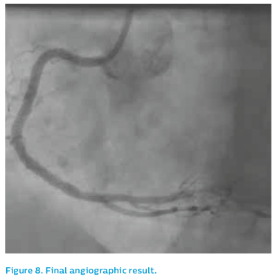 Figure 8. Final angiographic result
