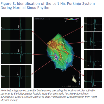 Identification of the Left His-Purkinje System During Normal Sinus Rhythm