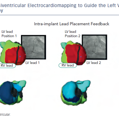 Figure 8 Intraprocedural Use of Biventricular Electrocardiomapping to Guide the Left Ventricular Lead Placement forCardiac Resynchronisation Therapy