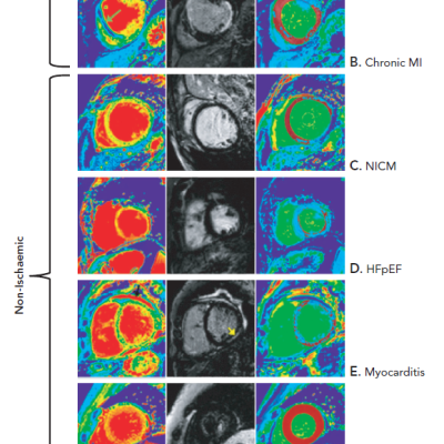 Figure 8 Multiparametric Cardiovascular Magnetic Resonance Tissue Characterisation