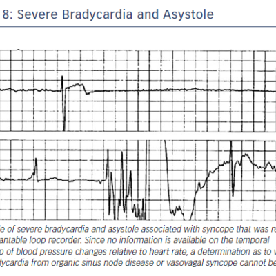 Figure 8 Severe Bradycardia and Asystole