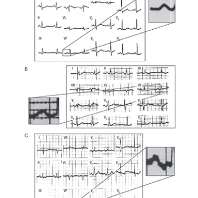 Figure 9 Progressive Interatrial Block – Three ECGs from a Patient with Mitro-aortic Valve Disease