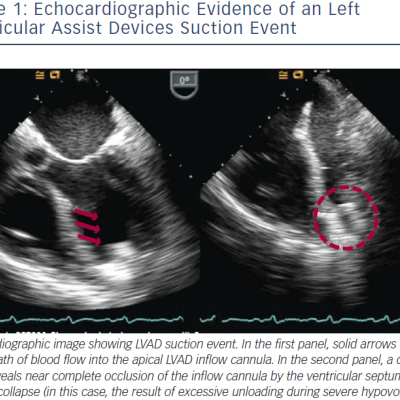Echocardiographic Evidence of an Left Ventricular Assist Devices Suction Event