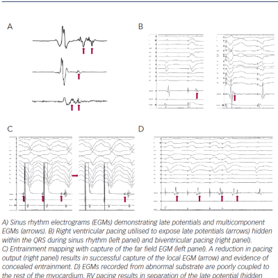 Arrhythmias in Transplanted Hearts and Main Underlying Mechanisms