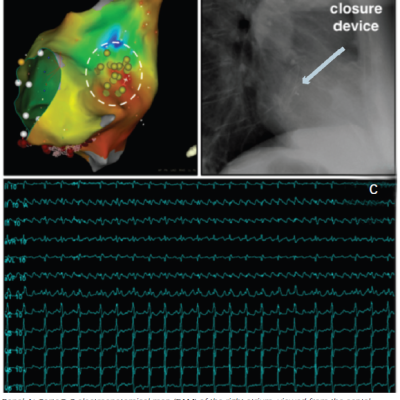 Electroanatomical Mapping of ASD Closure Device