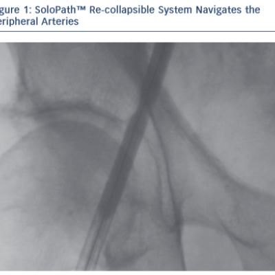 Figure 1 SoloPath™ Re-collapsible System Navigates the Peripheral Arteries