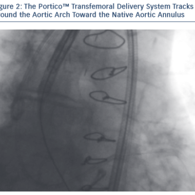 Figure 2 The Portico™ Transfemoral Delivery System Tracks Around the Aortic Arch Toward the Native Aortic Annulus