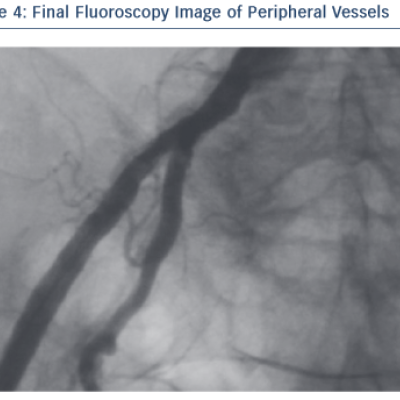 Figure 4 Final Fluoroscopy Image of Peripheral Vessels