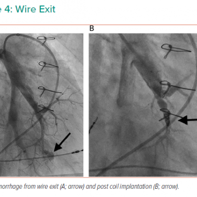 Wire Exit