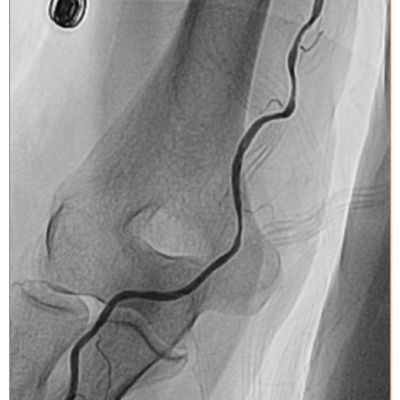 Angiography of Radial Artery Spasm