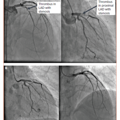 Comparison of Thrombus Burden in the First and Deferred Coronary Angiograms of the Patient