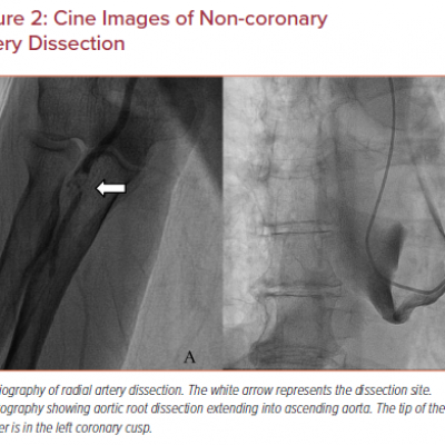 Cine Images of Non‑coronary Artery Dissection