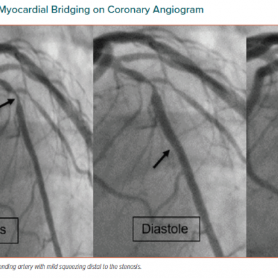 Manifestation of Myocardial Bridging on Coronary Angiogram