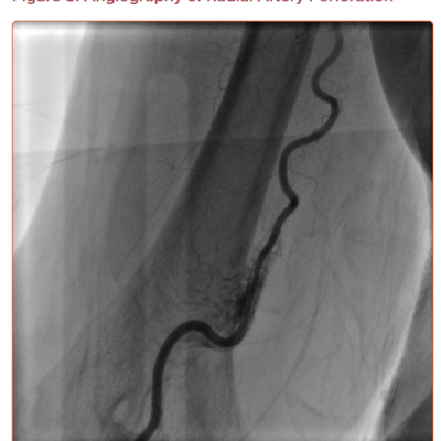 Angiography of Radial Artery Perforation
