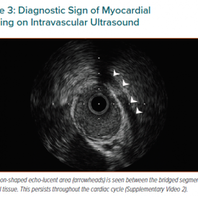 Diagnostic Sign of Myocardial Bridging on Intravascular Ultrasound