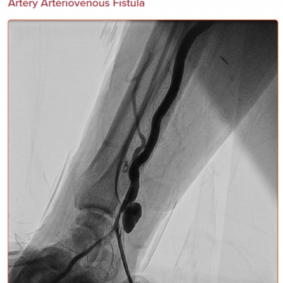 Angiography of Radial Artery Arteriovenous Fistula