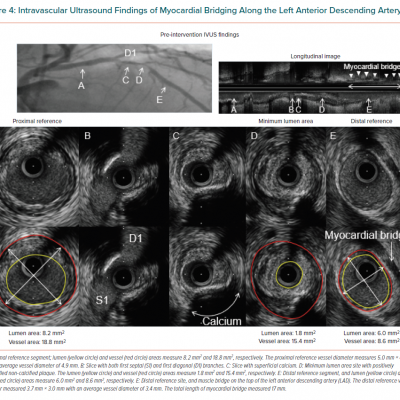 Intravascular Ultrasound Findings of Myocardial Bridging Along the Left Anterior Descending Artery