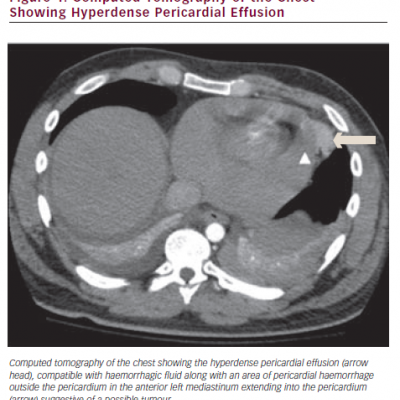  Computed Tomography of the Chest Showing Hyperdense Pericardial Effusion