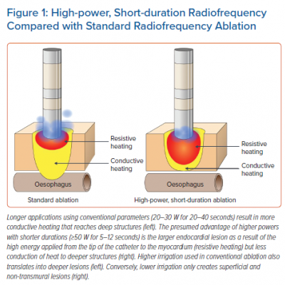 High-power Short-duration Radiofrequency Compared with Standard Radiofrequency Ablation