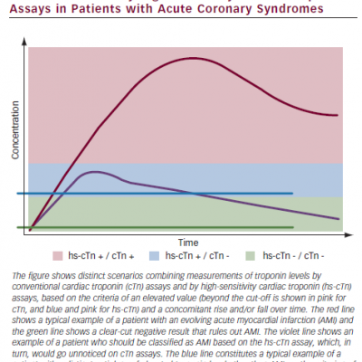 Kinetics of Cardiac Troponin and Detection by Conventional and by High-sensitivity Cardiac Troponin Assays in Patients with Acute Coronary Syndromes