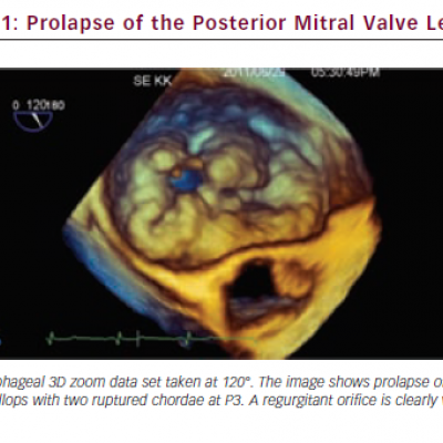 Prolapse of the Posterior Mitral Valve Leaflet