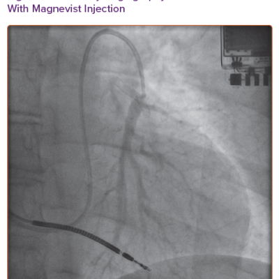 Pulmonary Angiography With Magnevist Injection