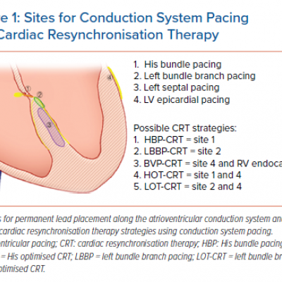 Sites for Conduction System Pacing and Cardiac Resynchronisation Therapy