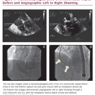 Transoesophageal Echo of a Ventricular Septal Defect and Angiographic Left to Right Shunting