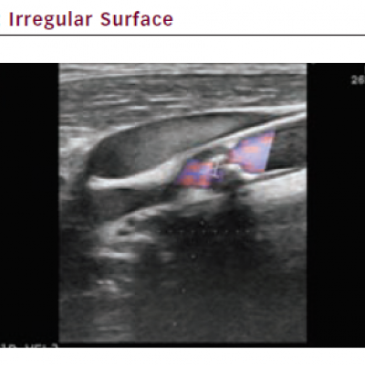 Irregular Surface