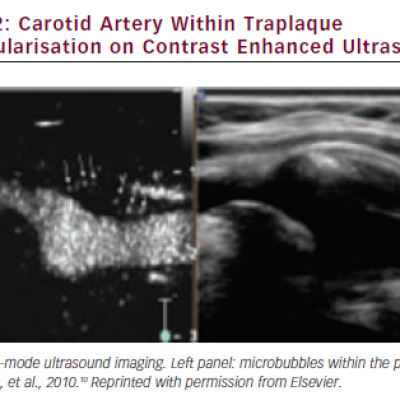 Carotid Artery Within Traplaque Neovascularisation on Contrast Enhanced Ultrasound