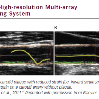 High-resolution Multi-array Echo-tracking System