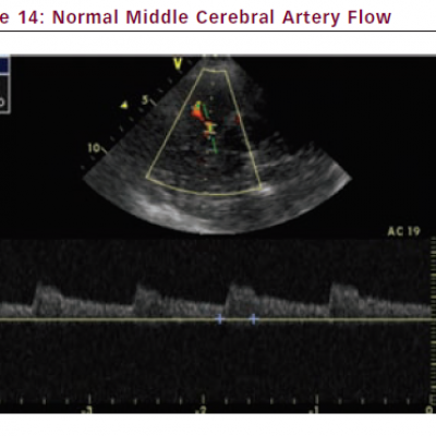 Normal Middle Cerebral Artery Flow