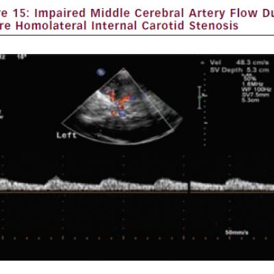 Impaired Middle Cerebral Artery Flow Due to Severe Homolateral Internal Carotid Stenosis