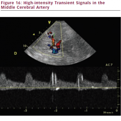 High-intensity Transient Signals in the Middle Cerebral Artery