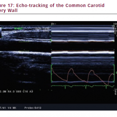 Echo-tracking of the Common Carotid Artery Wall