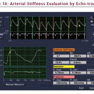 Arterial Stiffness Evaluation by Echo-tracking