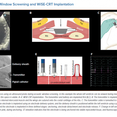 Acoustic Window Screening and WiSE-CRT Implantation