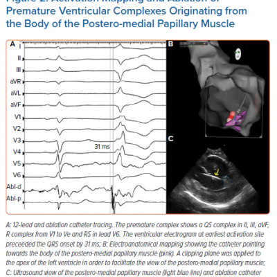 Activation Mapping and Ablation of Premature Ventricular Complexes Originating from the Body of the Postero-medial Papillary Muscle