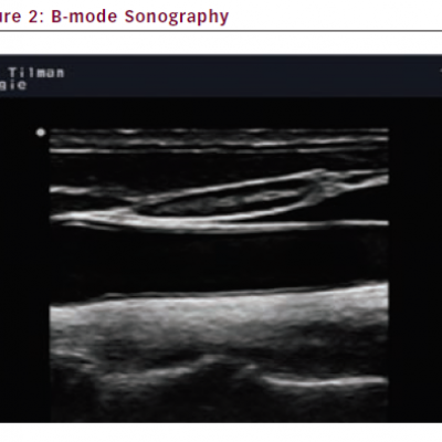 B-mode Sonography