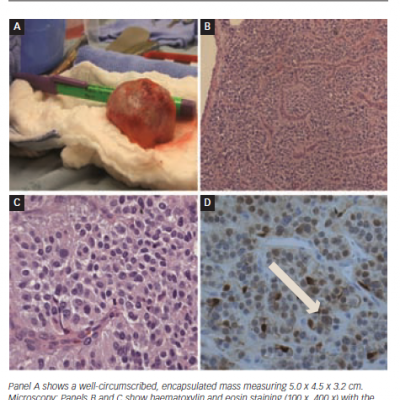 Gross and Histopathological Images of the Resected Mass Paraganglioma