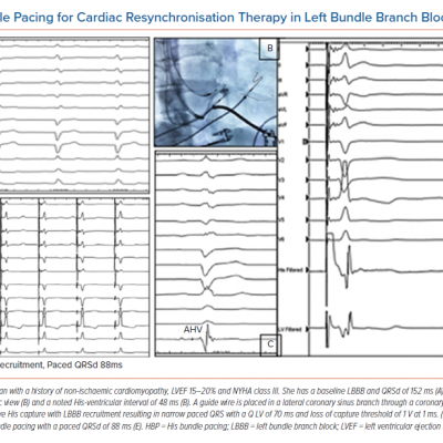 His Bundle Pacing for Cardiac Resynchronisation Therapy in Left Bundle Branch Block