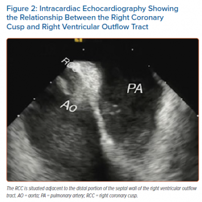Intracardiac Echocardiography Showing the Relationship Between the Right Coronary Cusp and Right Ventricular Outflow Tract