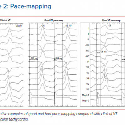 Pace-mapping