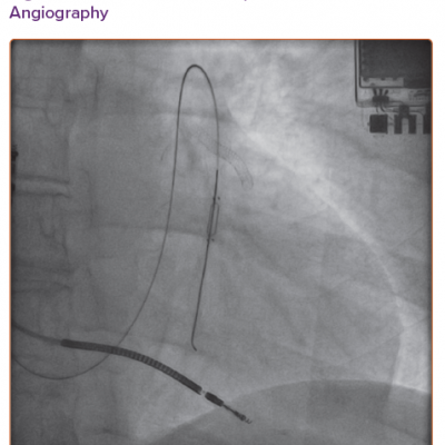 Post-CardioMEMS Implantation Angiography