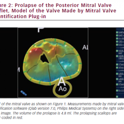 Prolapse of the Posterior Mitral Valve Leaflet Model of the Valve Made by Mitral Valve Quantification Plug-in