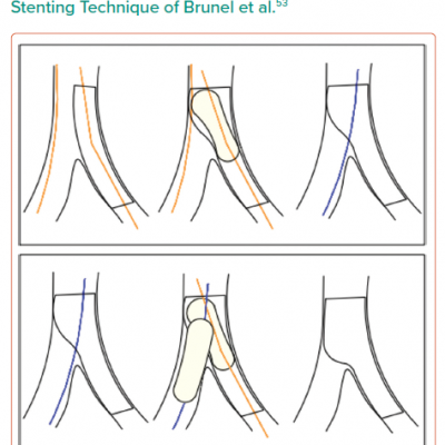 Schematic of the Inverted Provisional Stenting Technique of Brunel et al