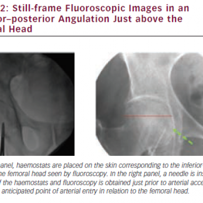  Still-frame Fluoroscopic Images in an Anterior–posterior Angulation Just above the Femoral Head