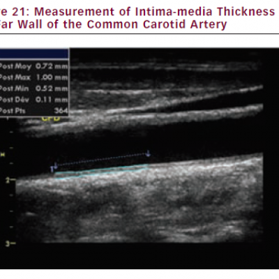 Measurement of Intima-media Thickness on the Far Wall of the Common Carotid Artery