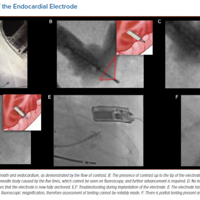 Anchoring of the Endocardial Electrode